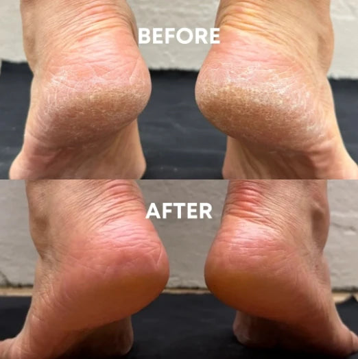 Electric Pedicure Device | Feet Dead Skin Remover